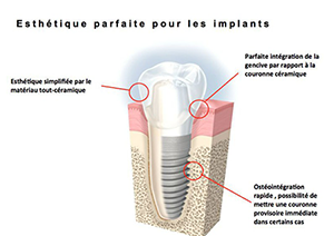 Implant dentaire La Garenne-Colombes