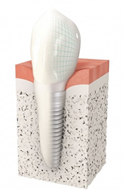 Implant dentaire La Garenne-Colombes